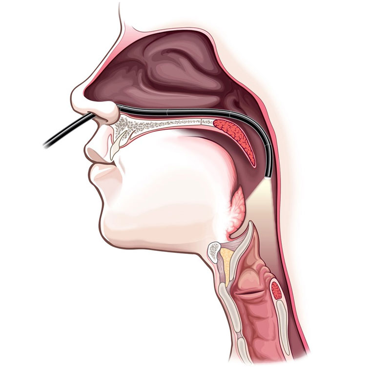 nasoendoscopy